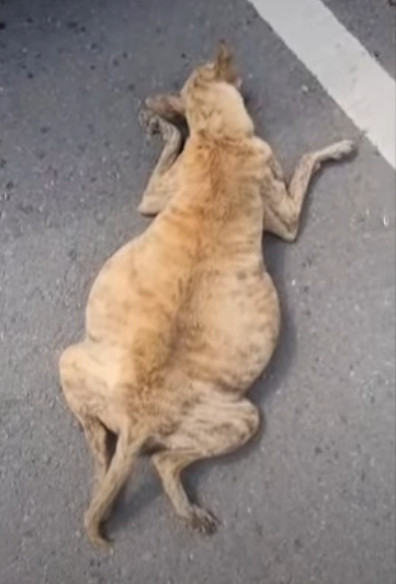 After a procedure to remove 9000ml of as...